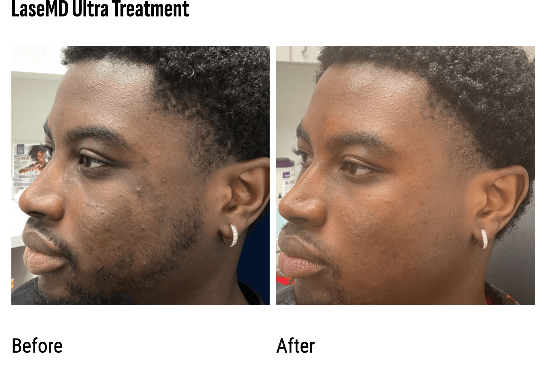 Black man who underwent laser 